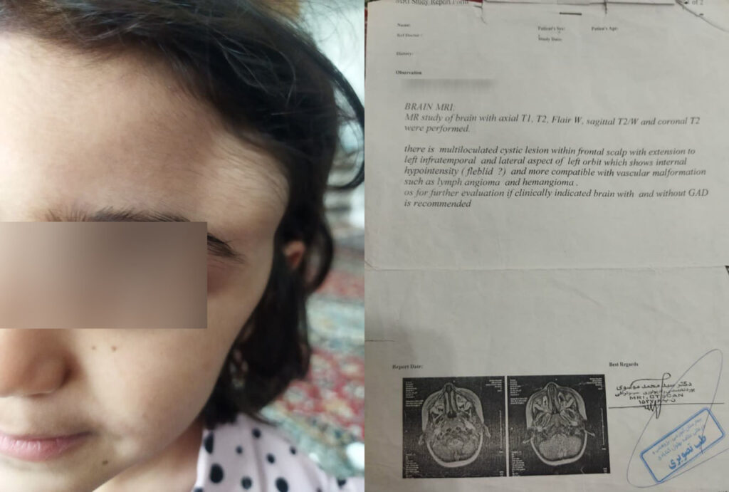 انجام عمل رایگان کودک محروم مبتلا به بیماری توده چشمی در تهران با پیگیری دارالشفاء و دکتر محمدرضا دشتی